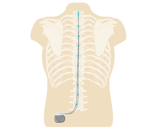 https://www.ibshospitals.com/specialityicon/63d358f6b9703spinal-cord-stimulation.png